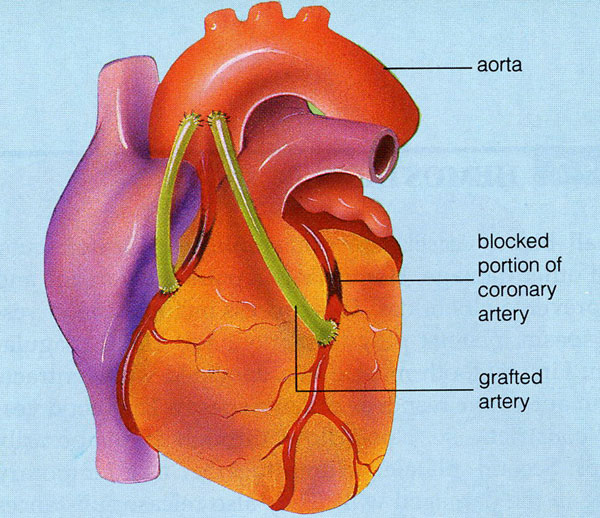 心脏搭桥手术 示意图图片